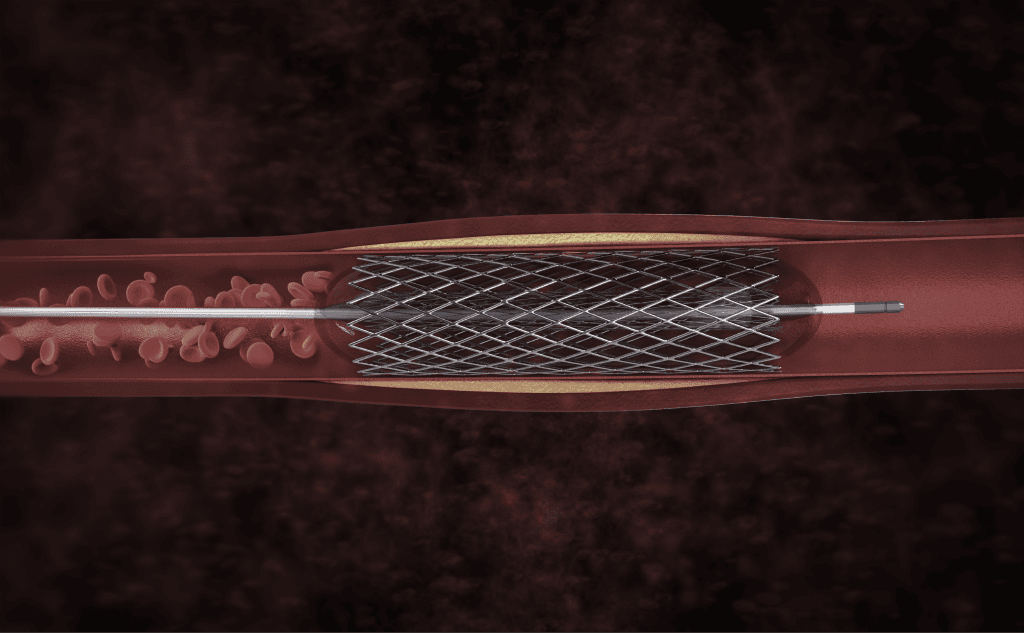 Coronary stent illustration for angioplasty