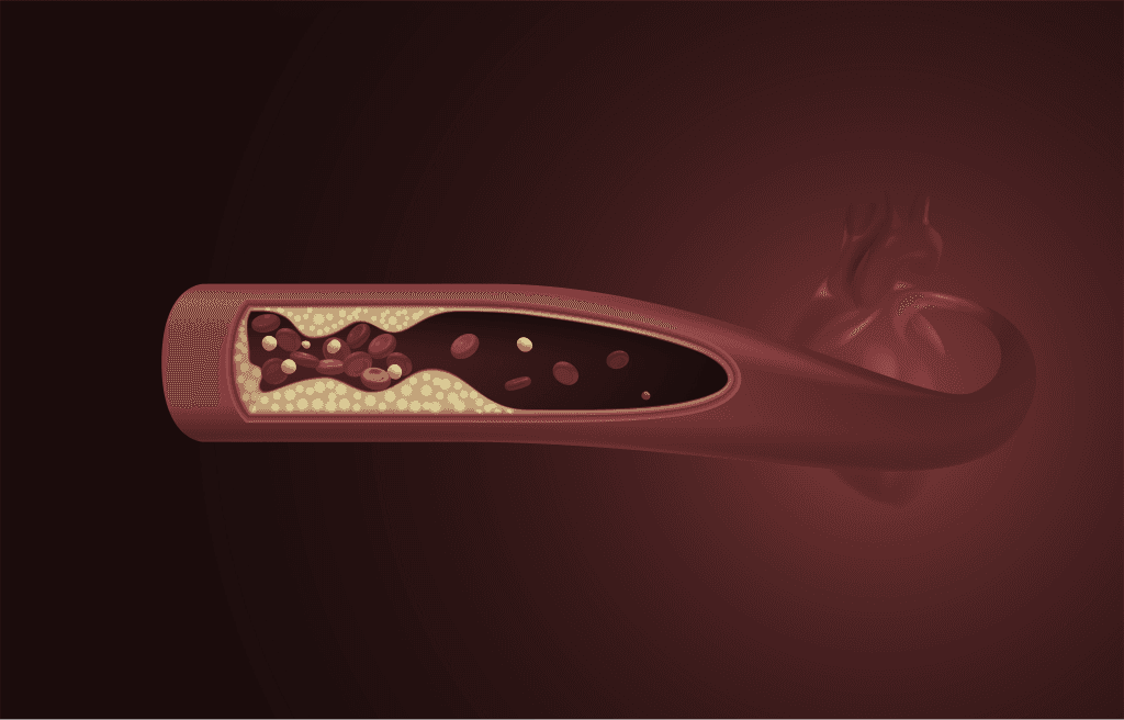 Coronary Artery Disease
